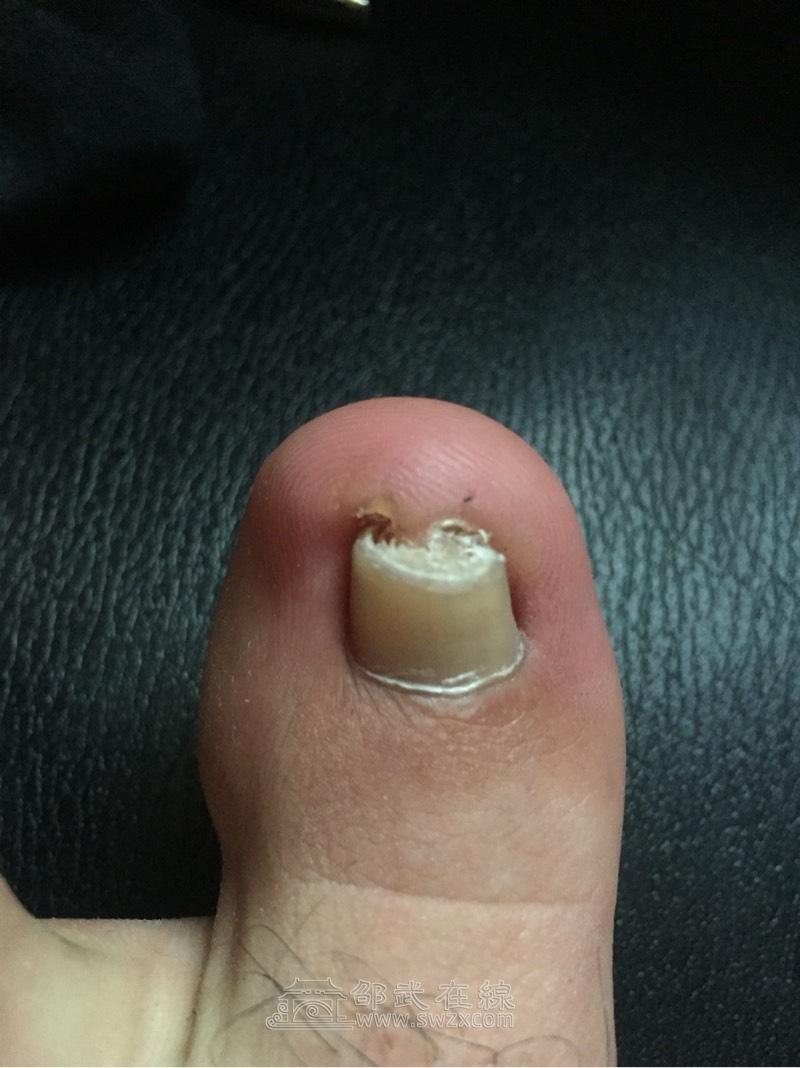 邵武哪里有治疗嵌甲的